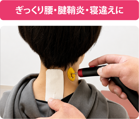 まなか鍼灸整骨院のぎっくり腰と寝違え施術